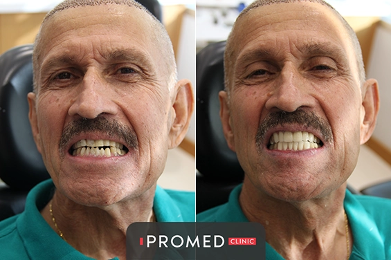 Before After 73