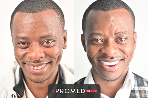 Before After 4