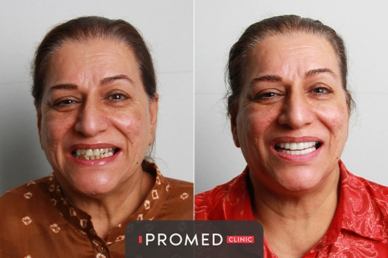 Before After 5