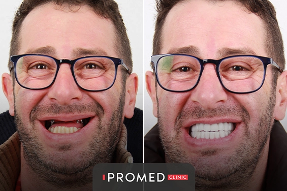 Before After 6