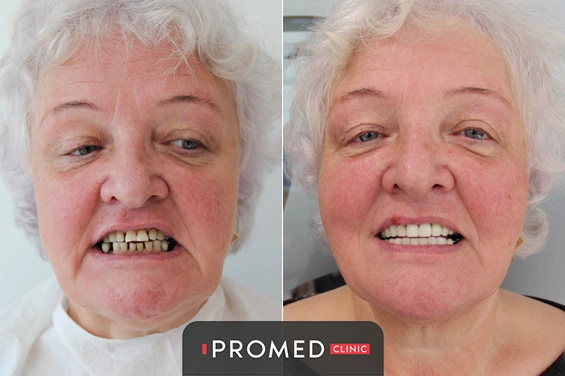 Before After 7
