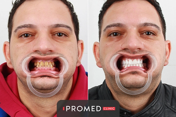 Before After 9