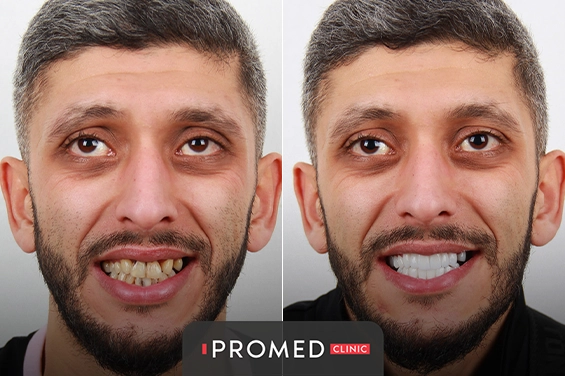 Before After 10