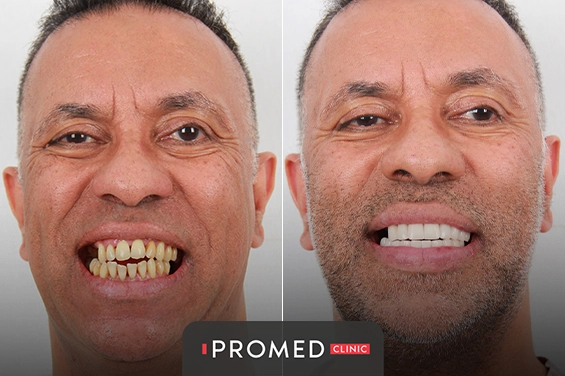 Before After 72